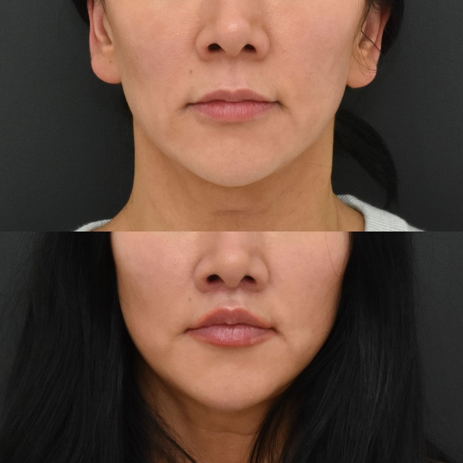Before and after facial treatment comparison image.