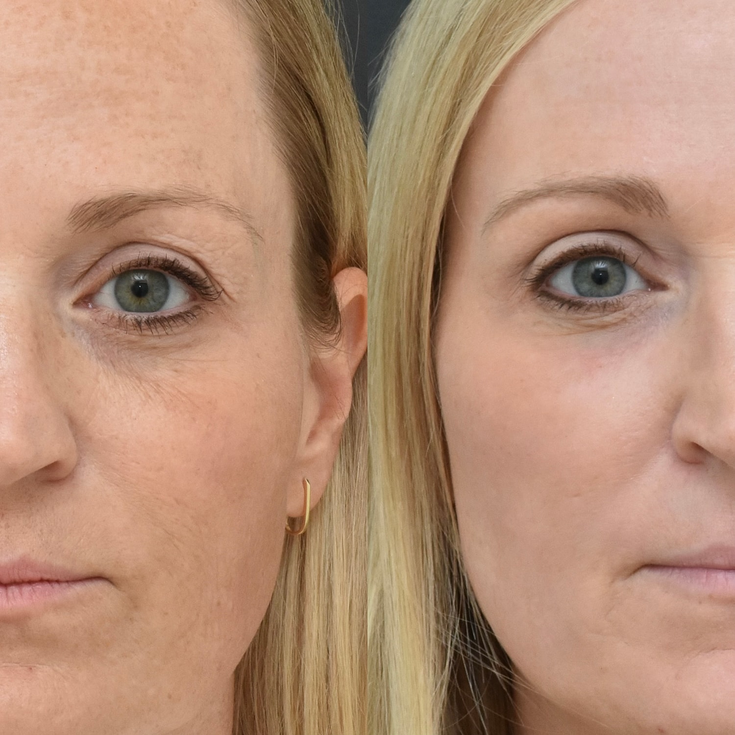 Comparison of two women's faces side by side.