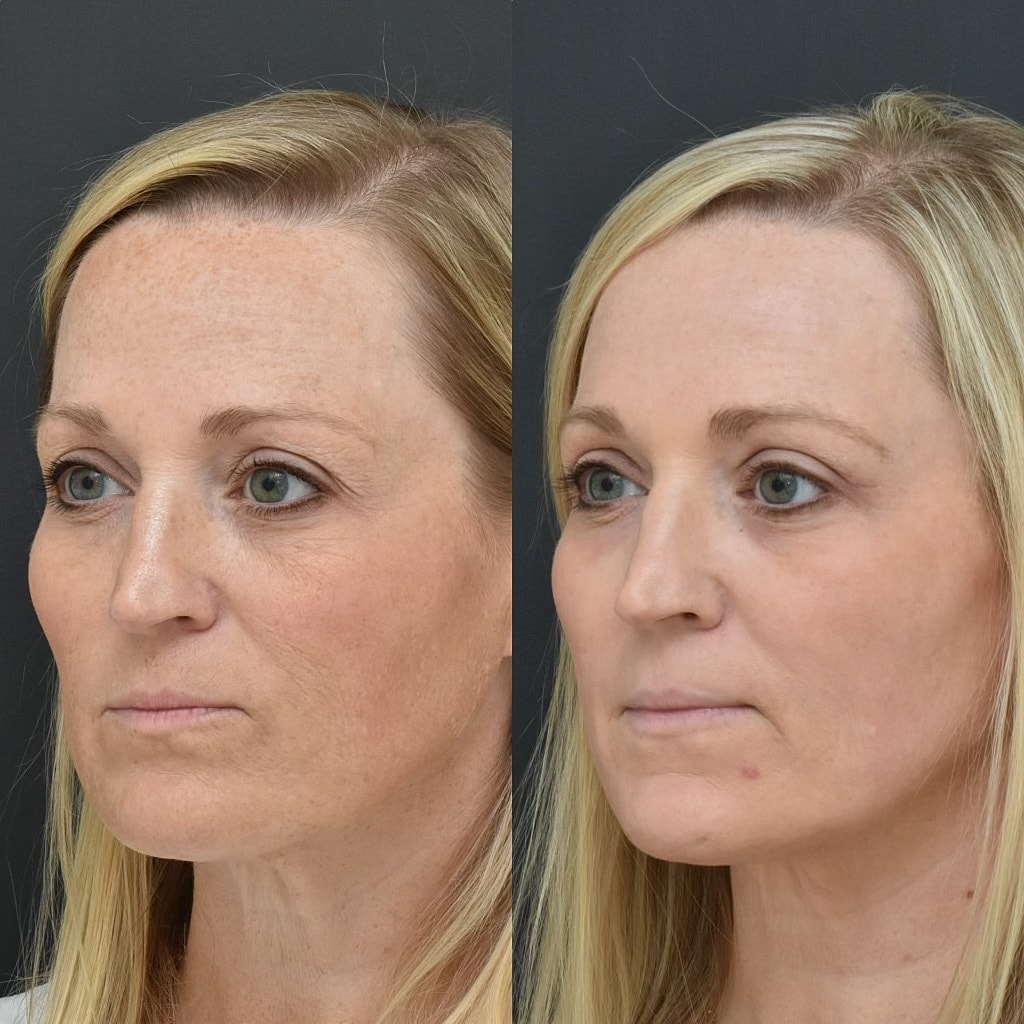 Before and after skin treatment comparison.