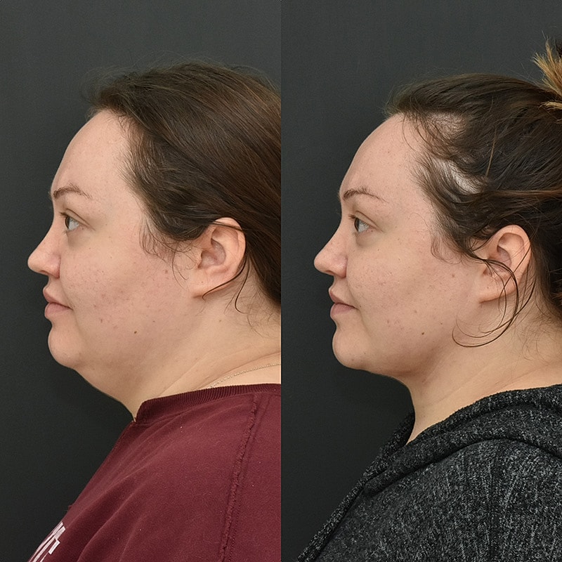 Before and after profile comparison of woman.