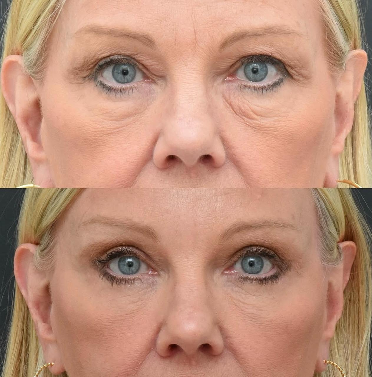 Before and after eye rejuvenation treatment comparison