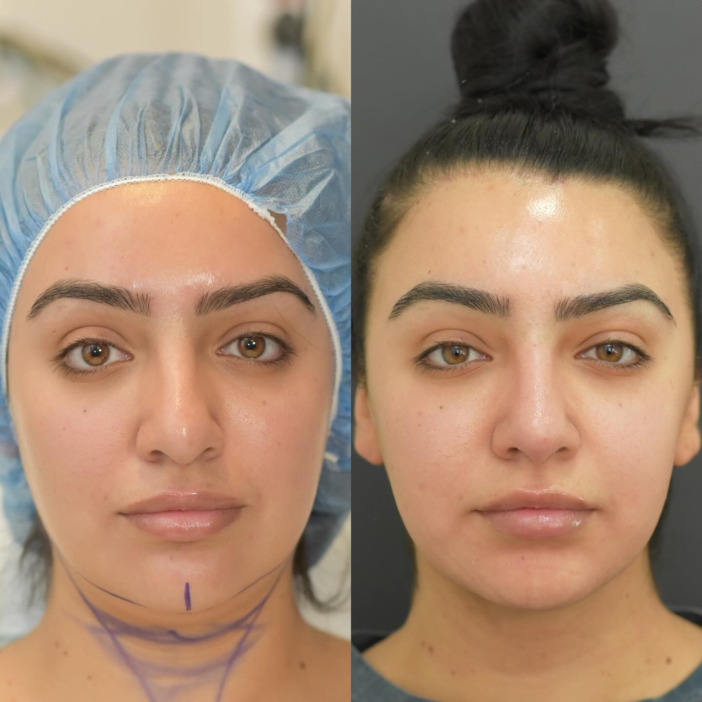 Buccal Fat Removal Before & After