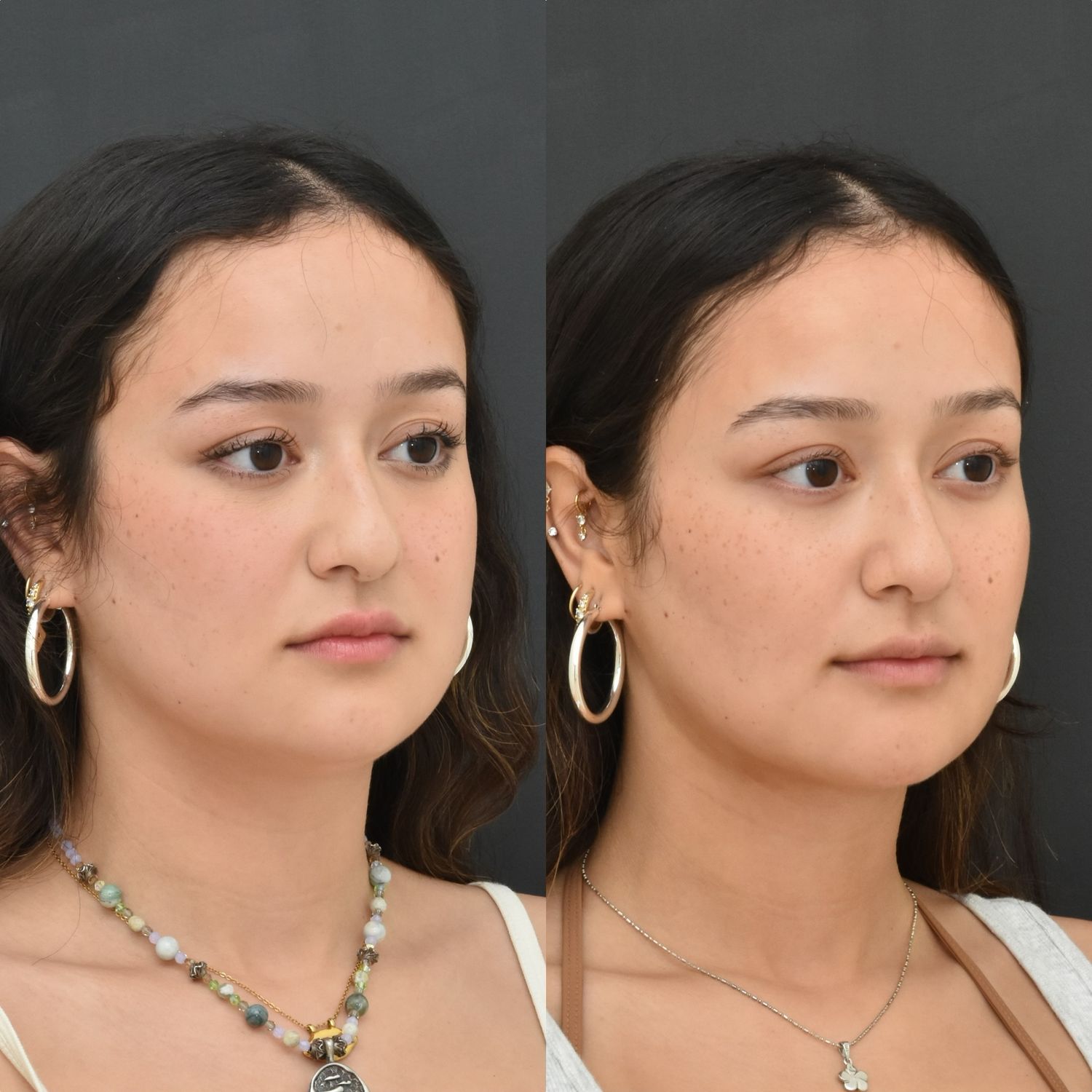 Buccal Fat Removal Before & After
