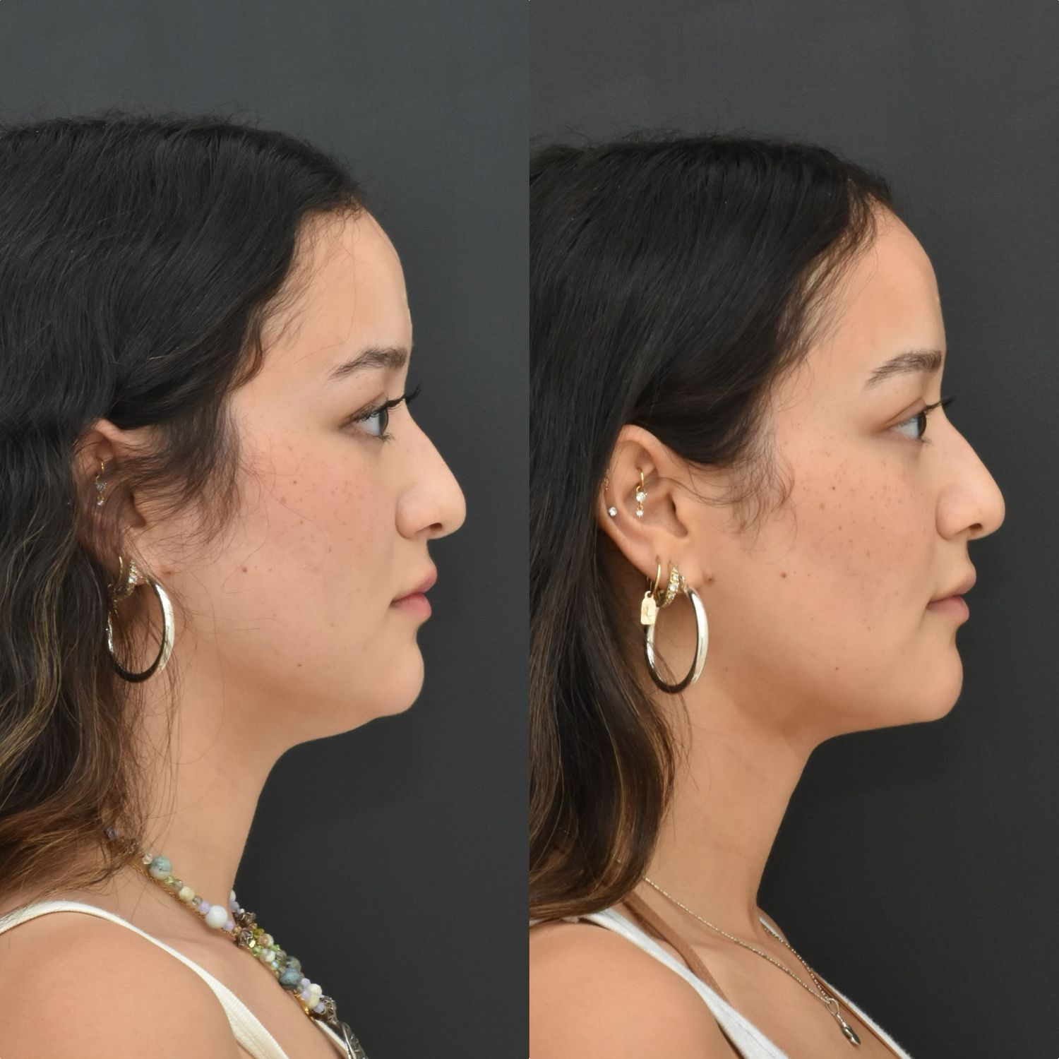 Buccal Fat Removal Before & After