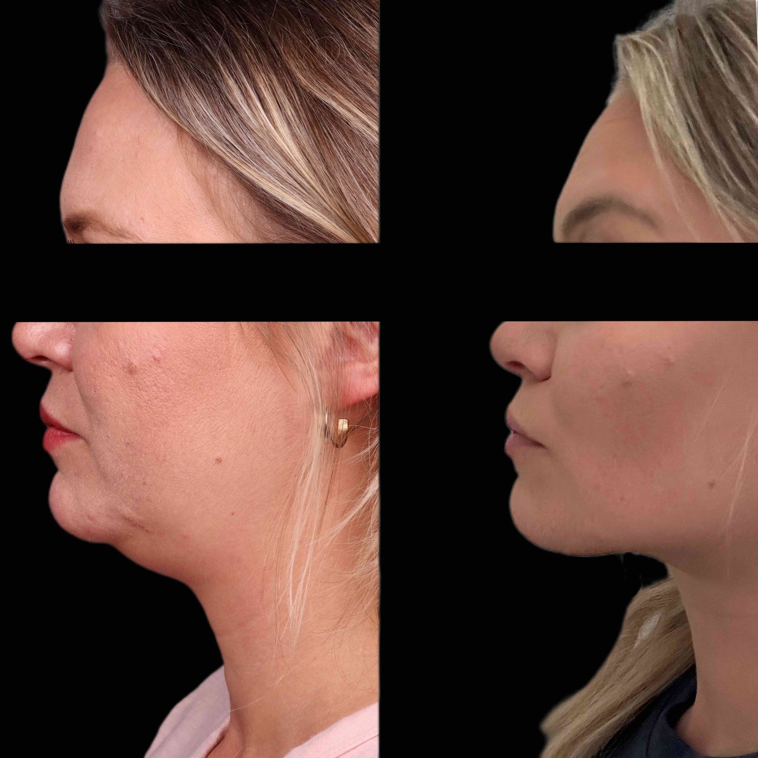 Buccal Fat Removal Before & After