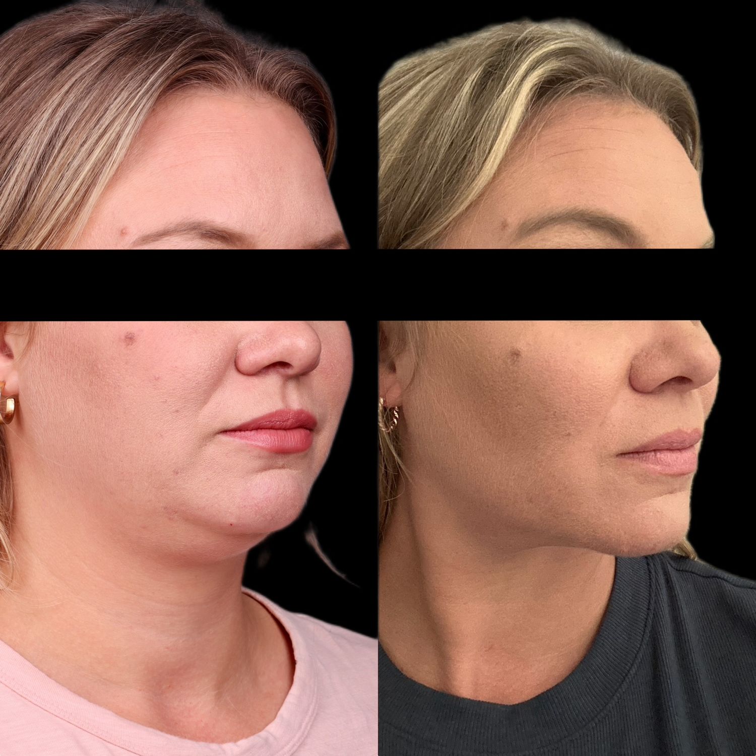Buccal Fat Removal Before & After