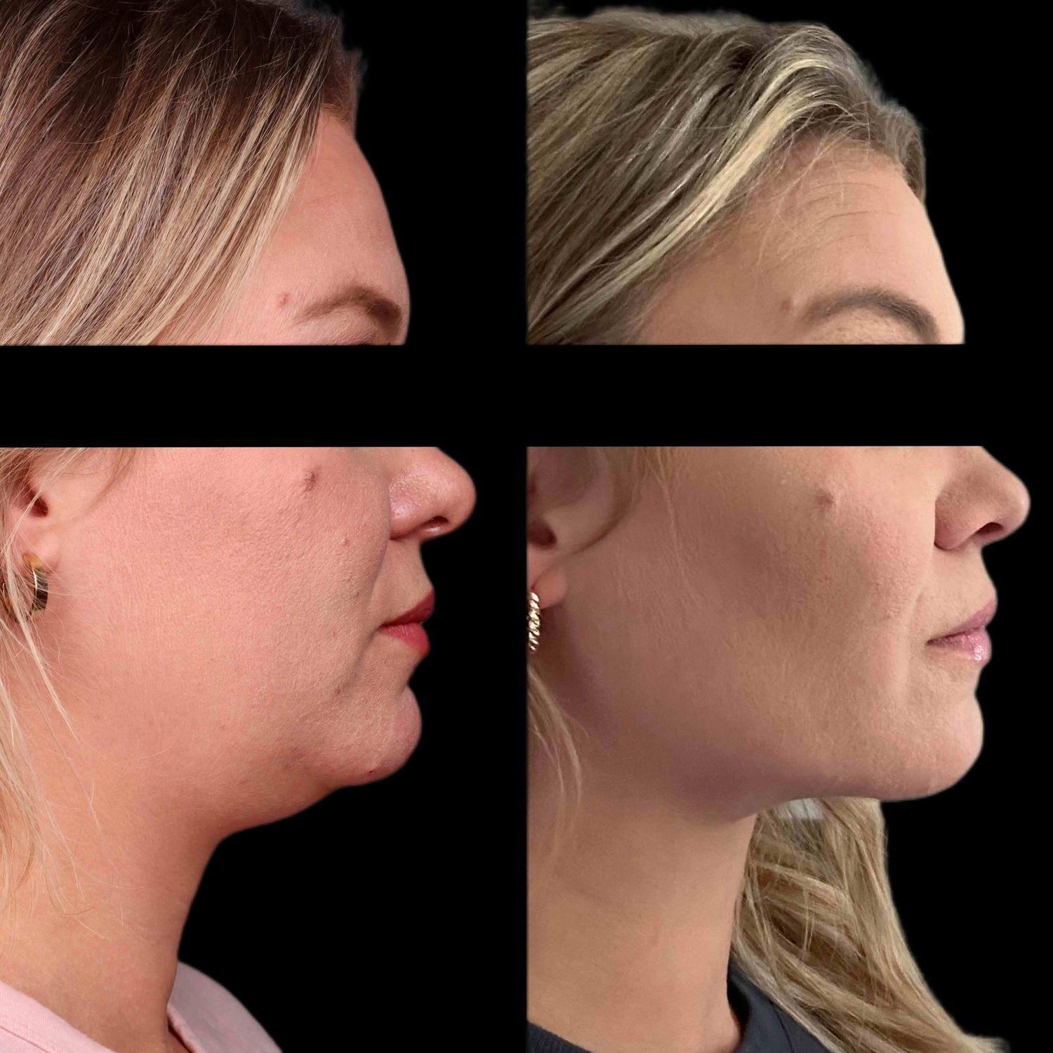 Buccal Fat Removal Before & After