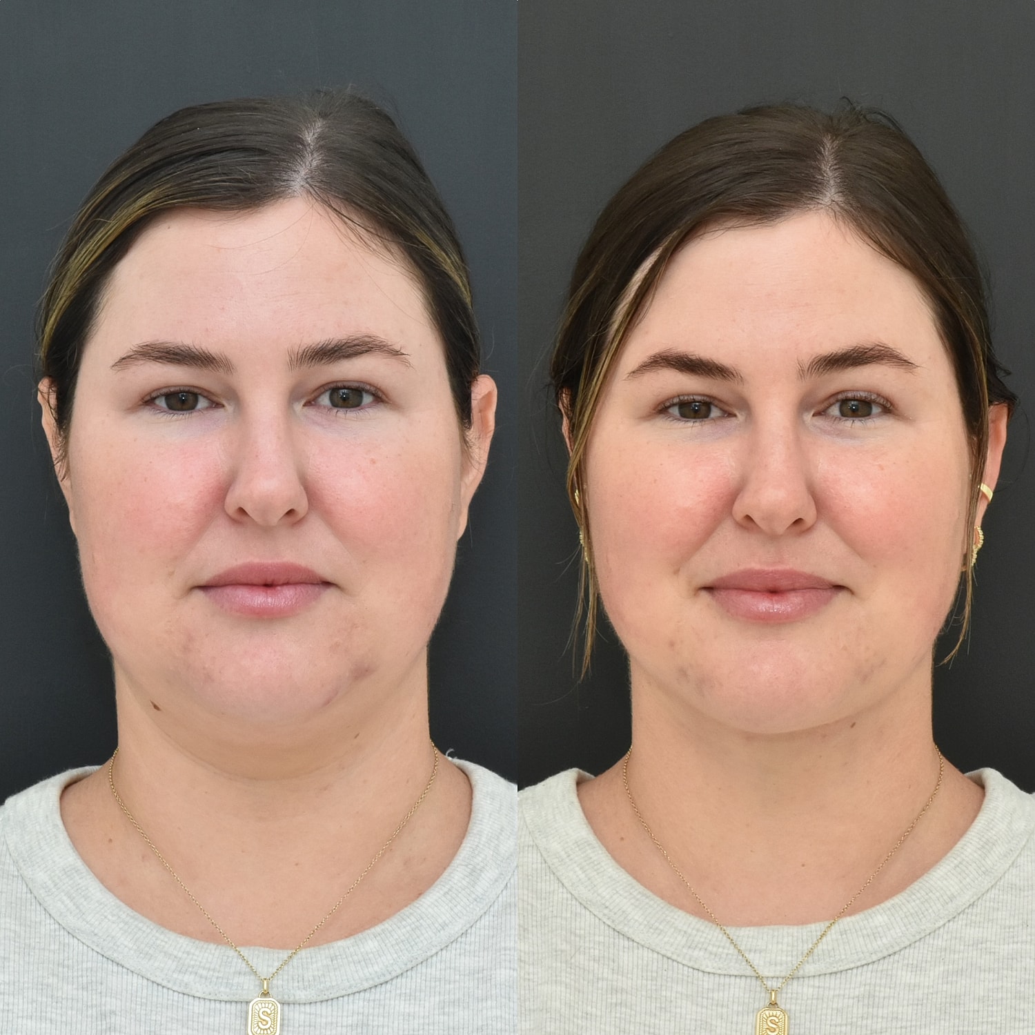 Buccal Fat Removal Before & After