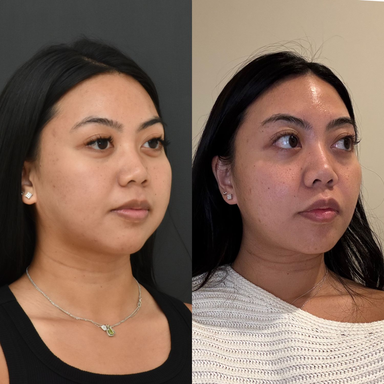 Buccal Fat Removal Before & After