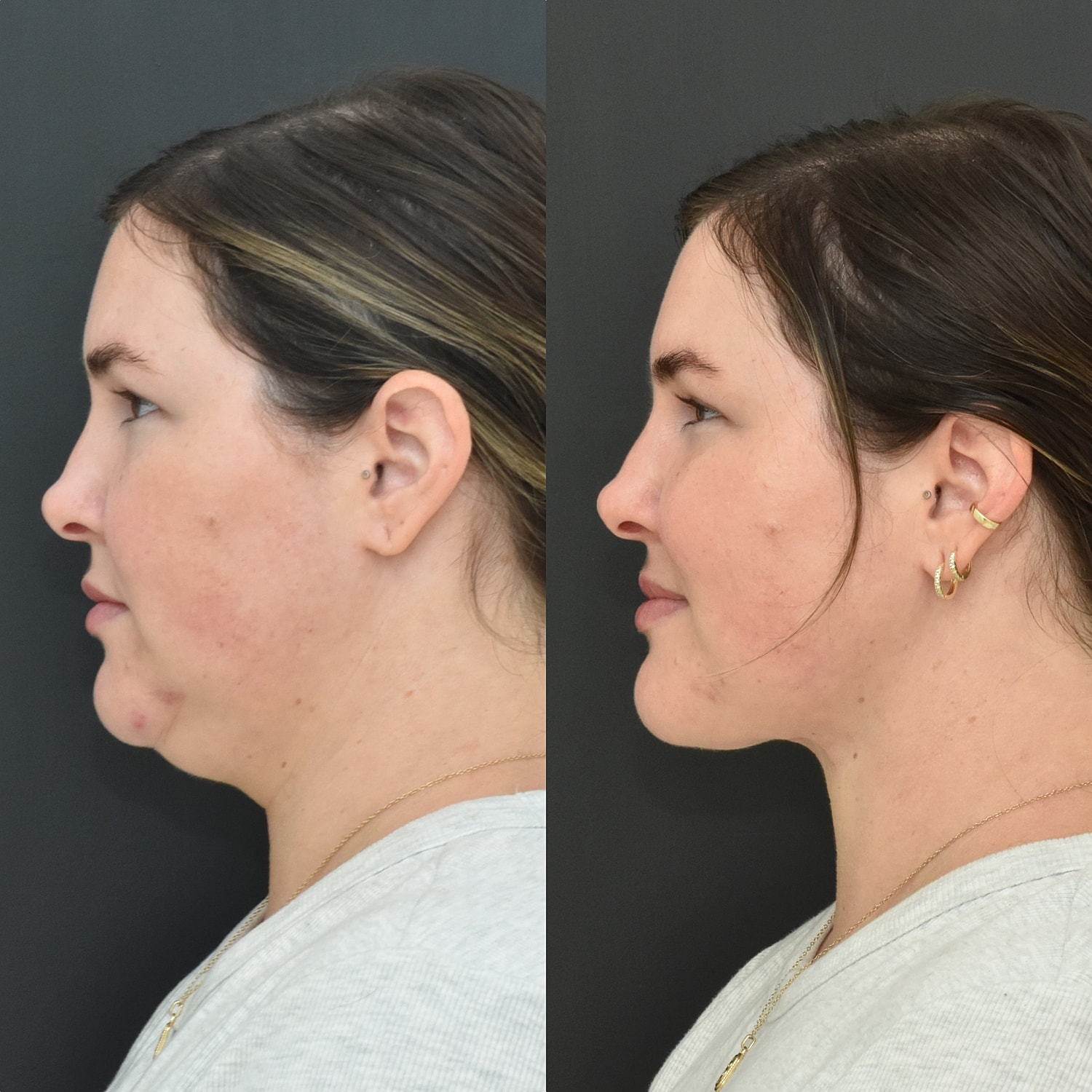 Buccal Fat Removal Before & After