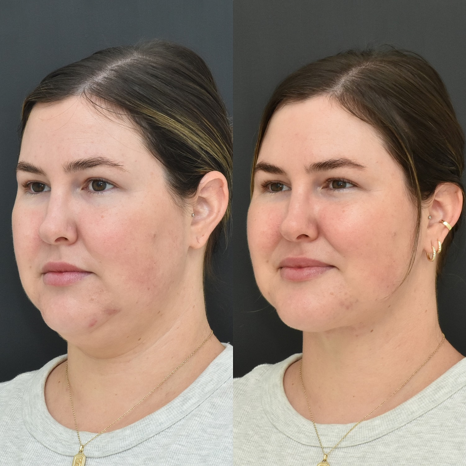 Buccal Fat Removal Before & After