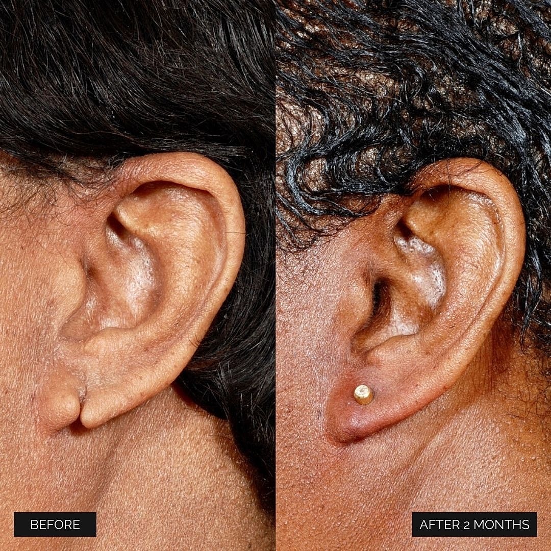 Reconstruction Before & After