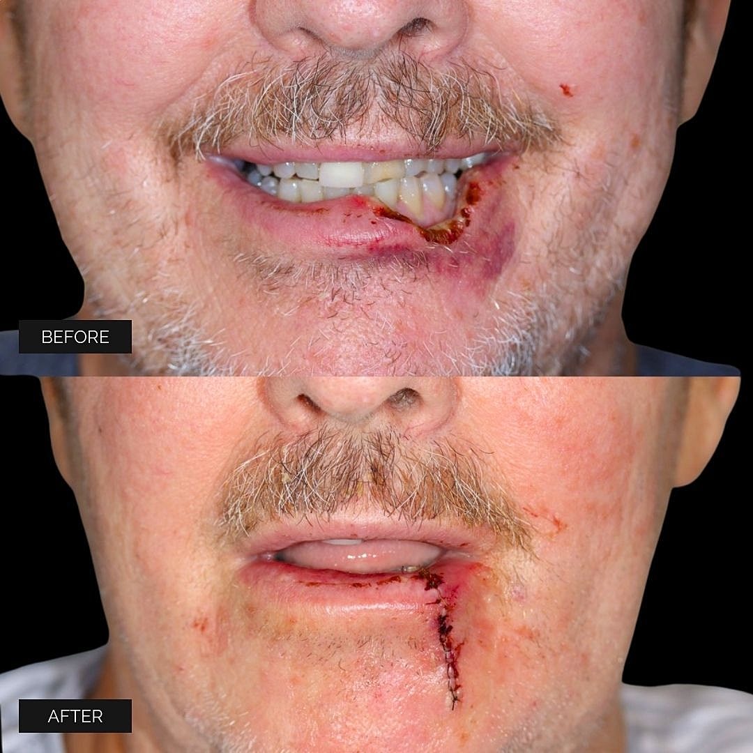 Reconstruction Before & After