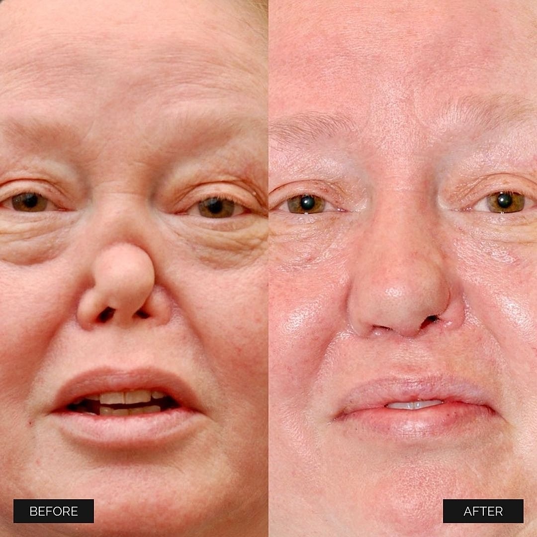 Reconstruction Before & After