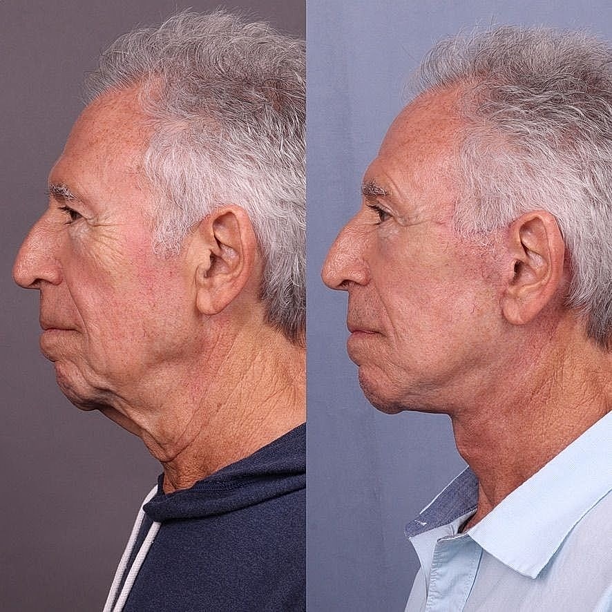 Neck Lift Gallery Before & After