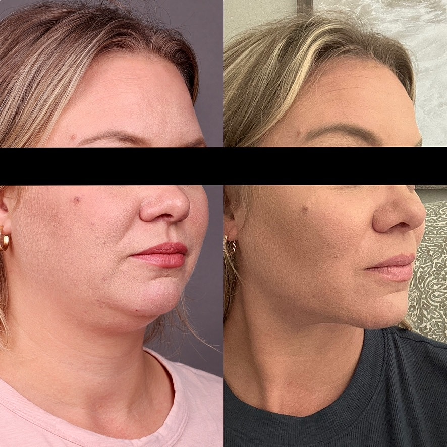 Necklift Before & After