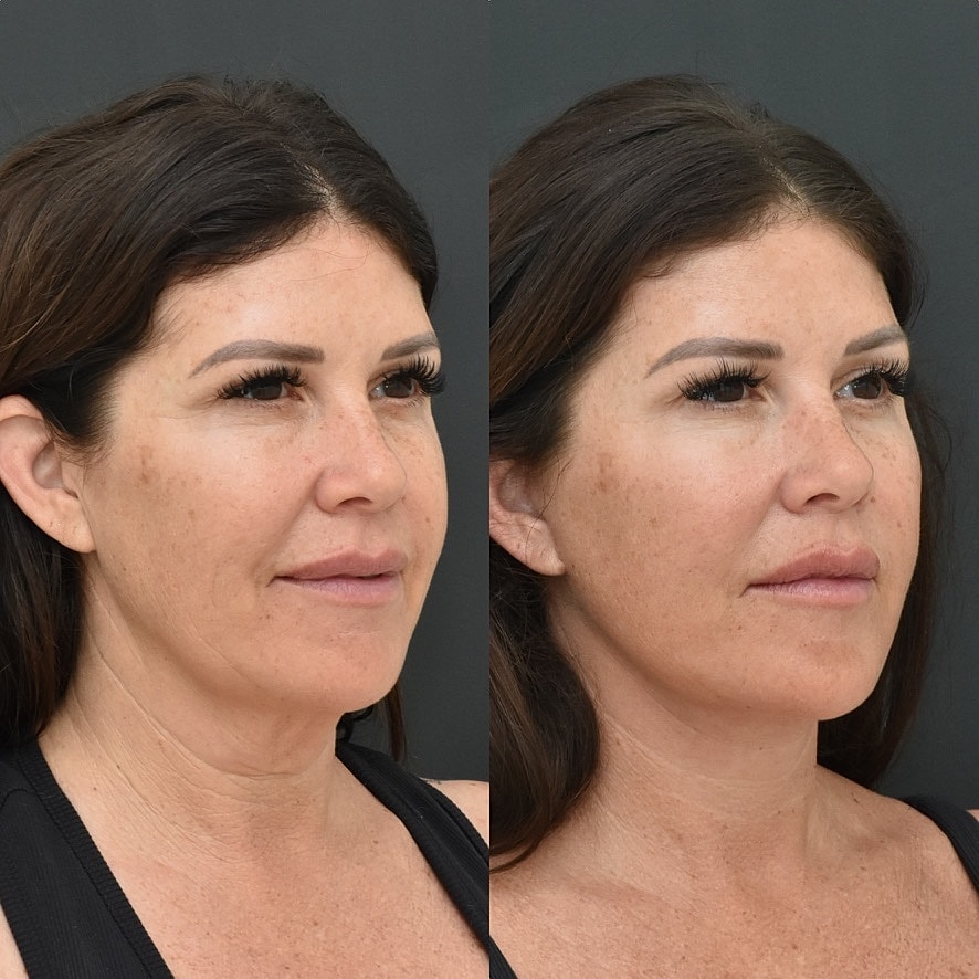 Necklift Before & After