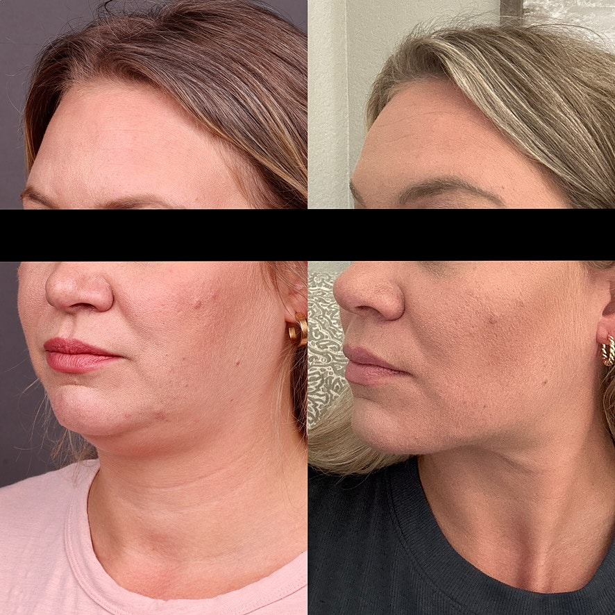 Necklift Before & After