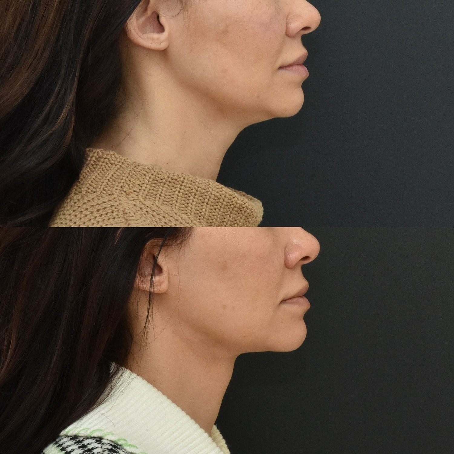 Necklift Before & After