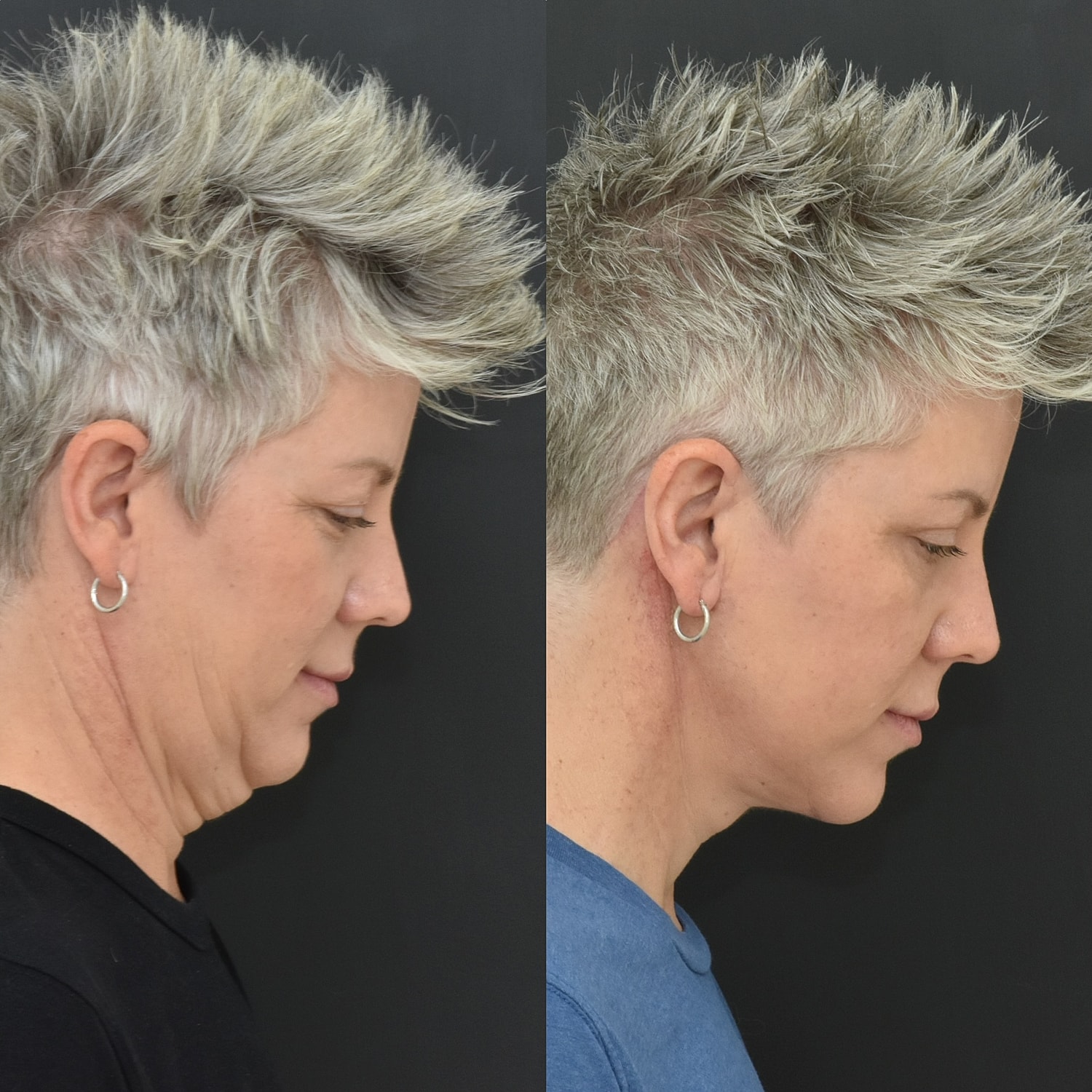 Necklift Before & After