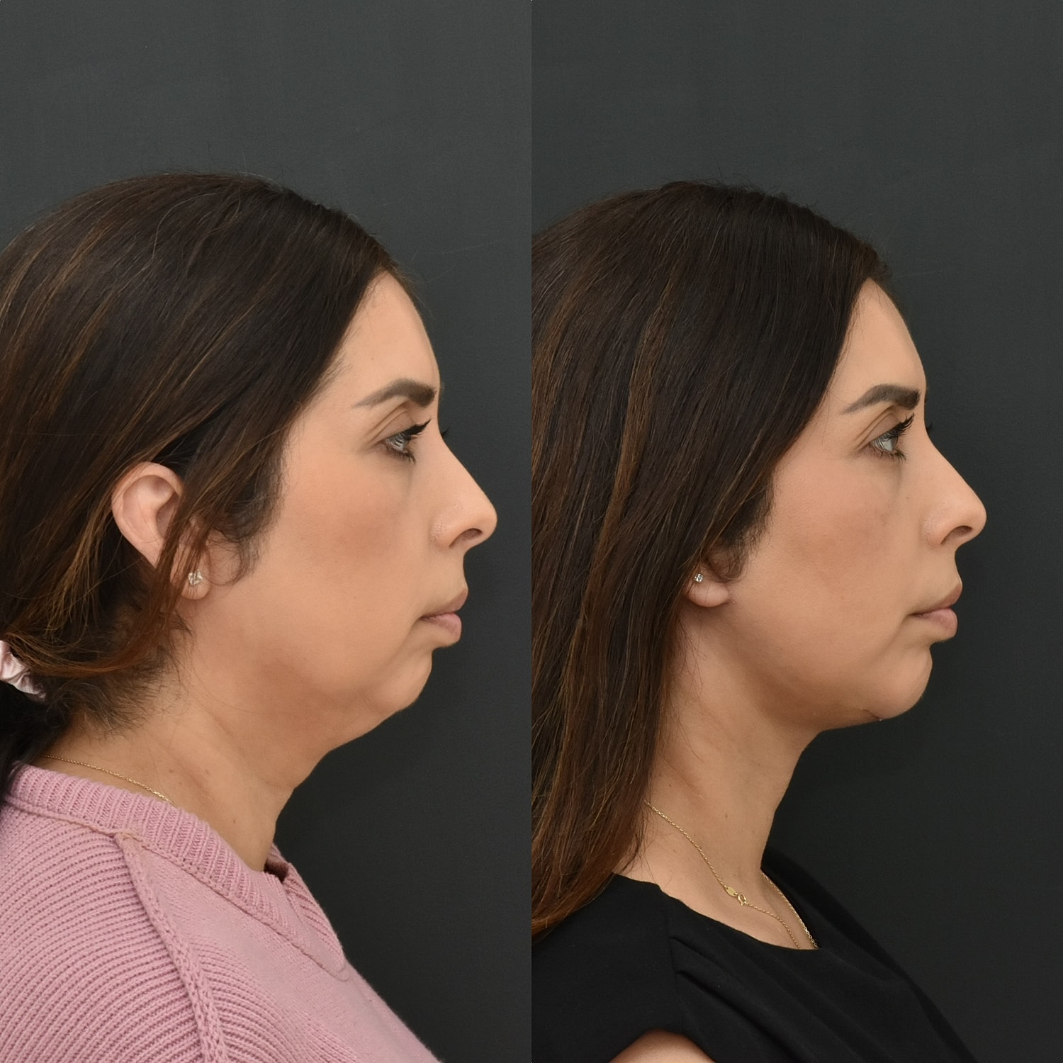 Necklift Before & After