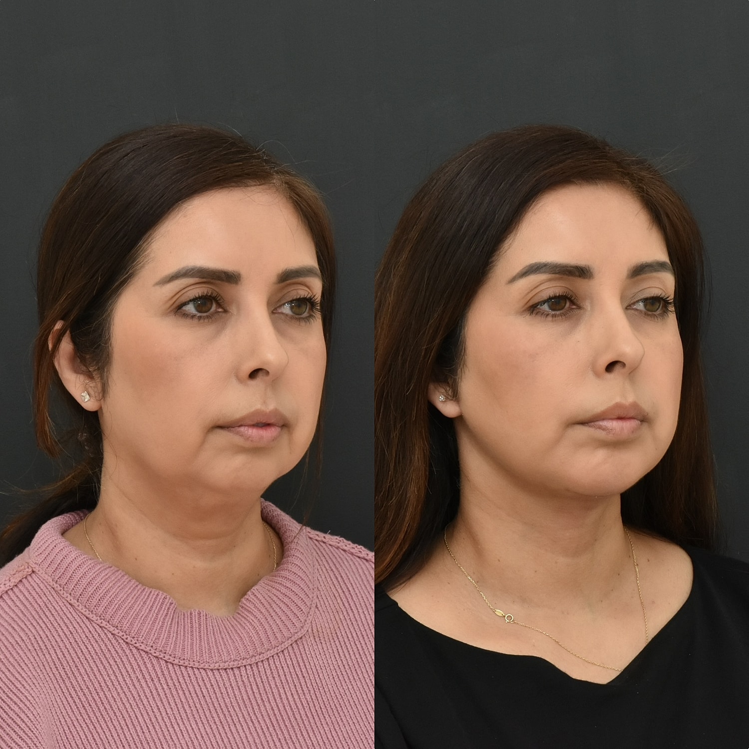 Necklift Before & After
