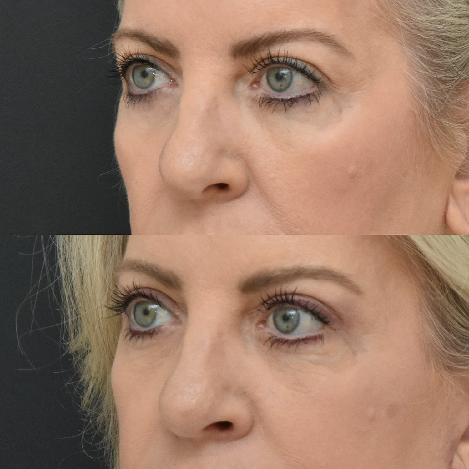 Brow Lift Before & After