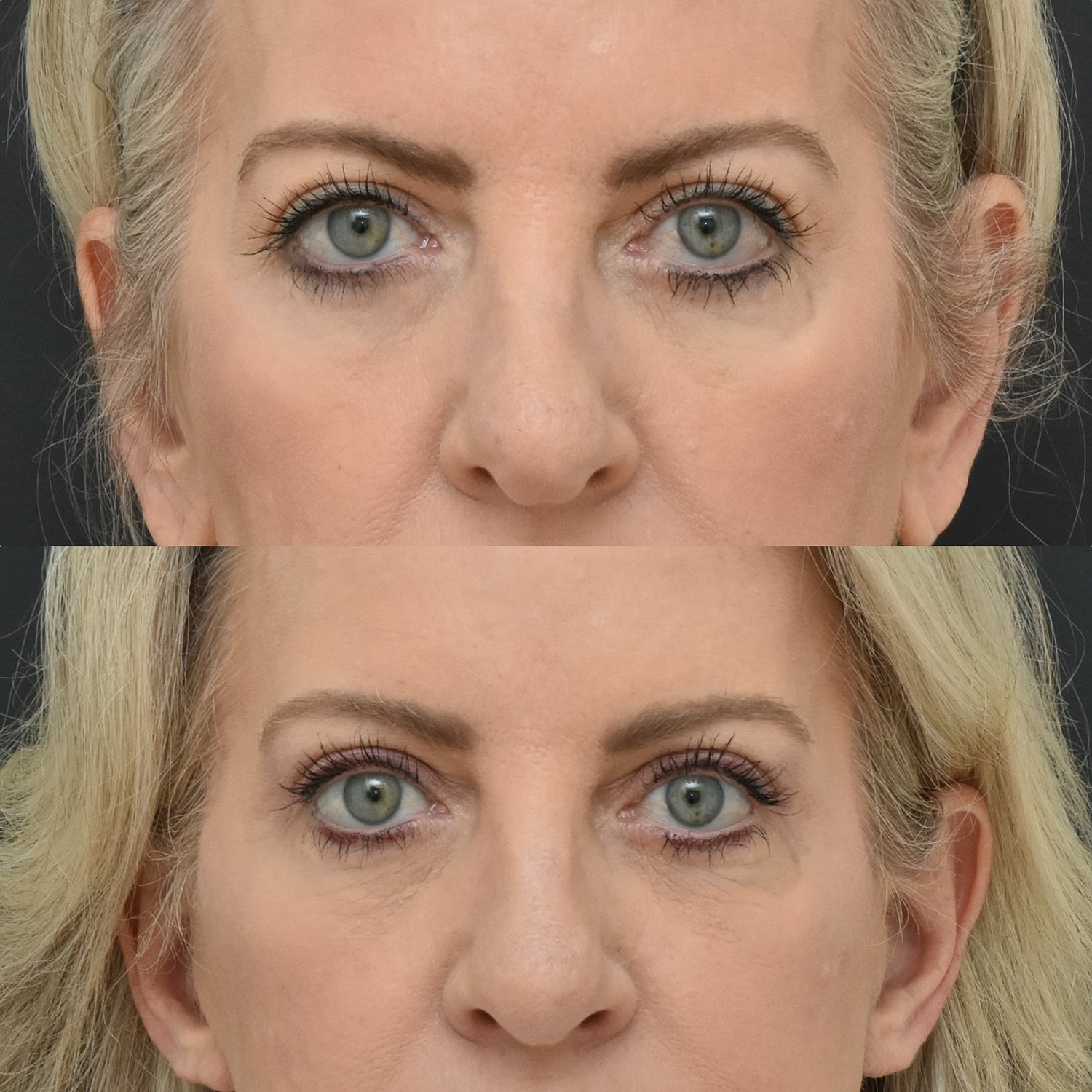 Brow Lift Before & After