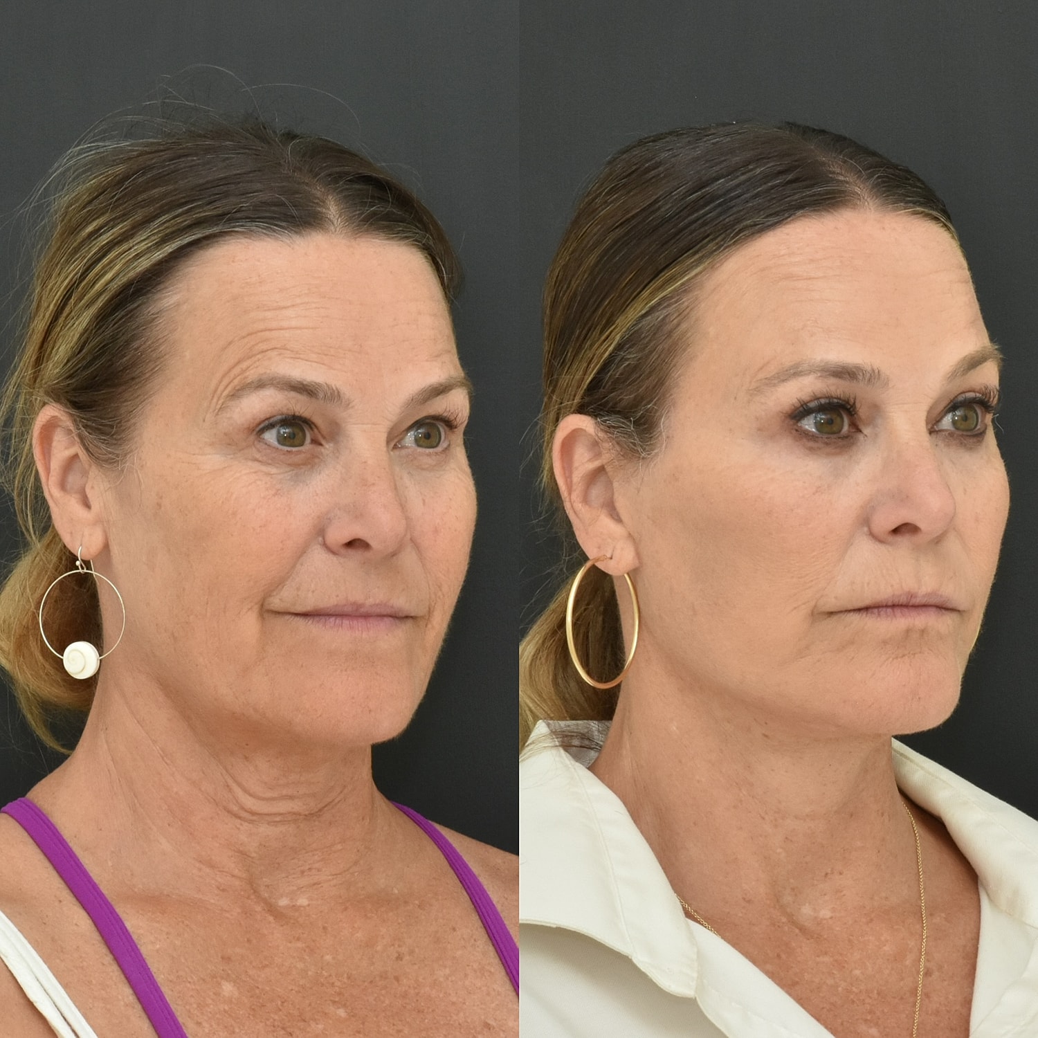 Brow Lift Before & After