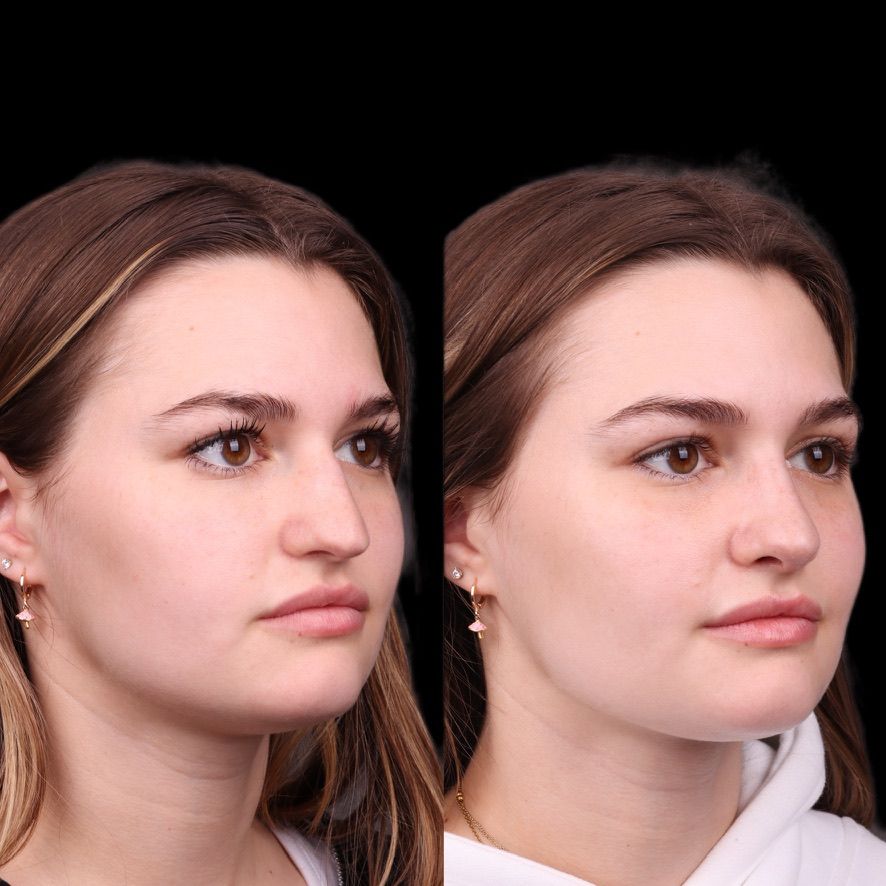Cosmetic Primary Rhinoplasty Before & After