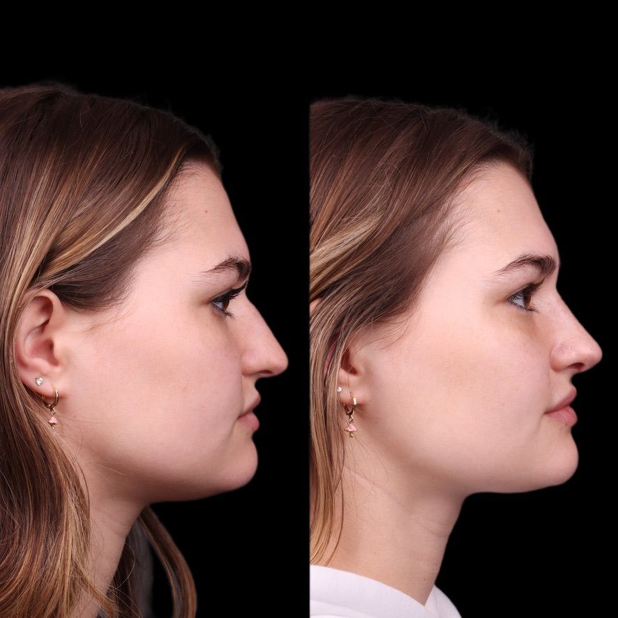Cosmetic Primary Rhinoplasty Before & After