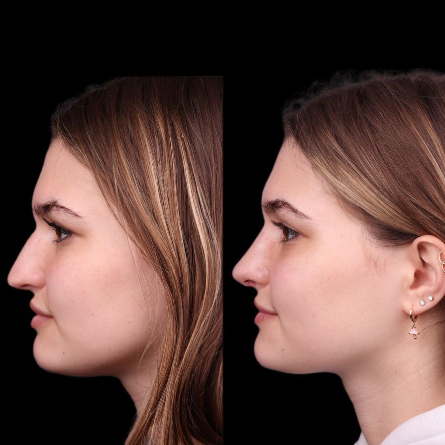 Cosmetic Primary Rhinoplasty Before & After