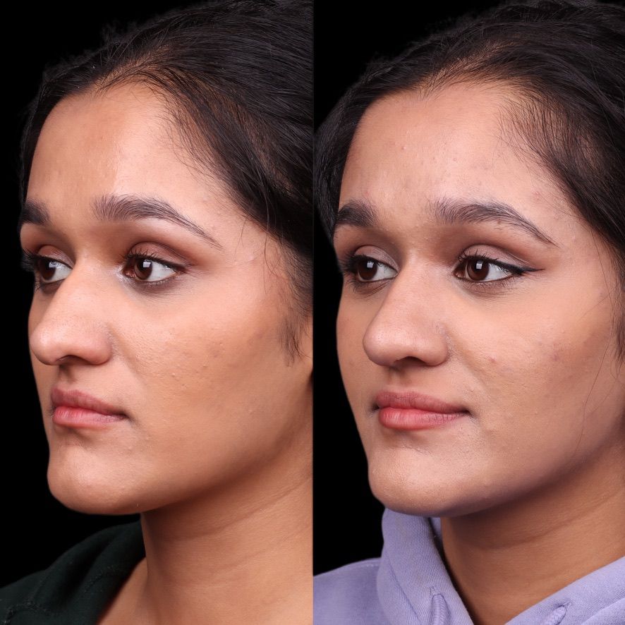 Cosmetic Primary Rhinoplasty Before & After
