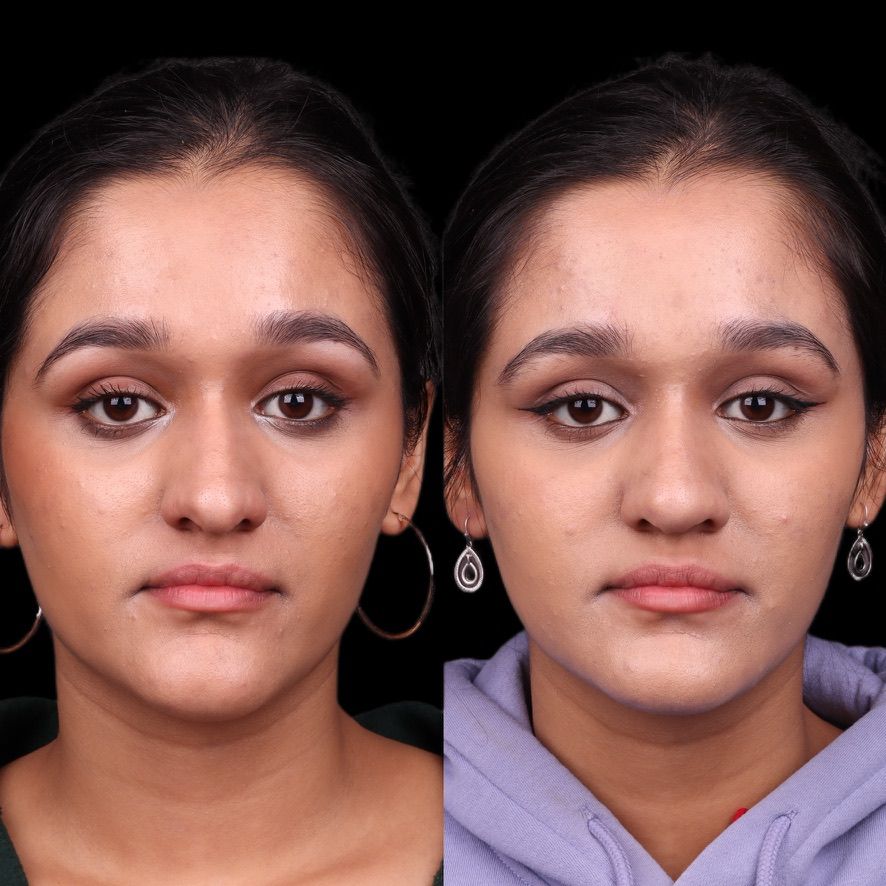 Cosmetic Primary Rhinoplasty Before & After