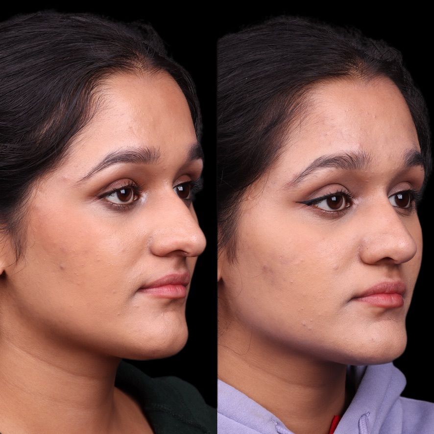 Cosmetic Primary Rhinoplasty Before & After