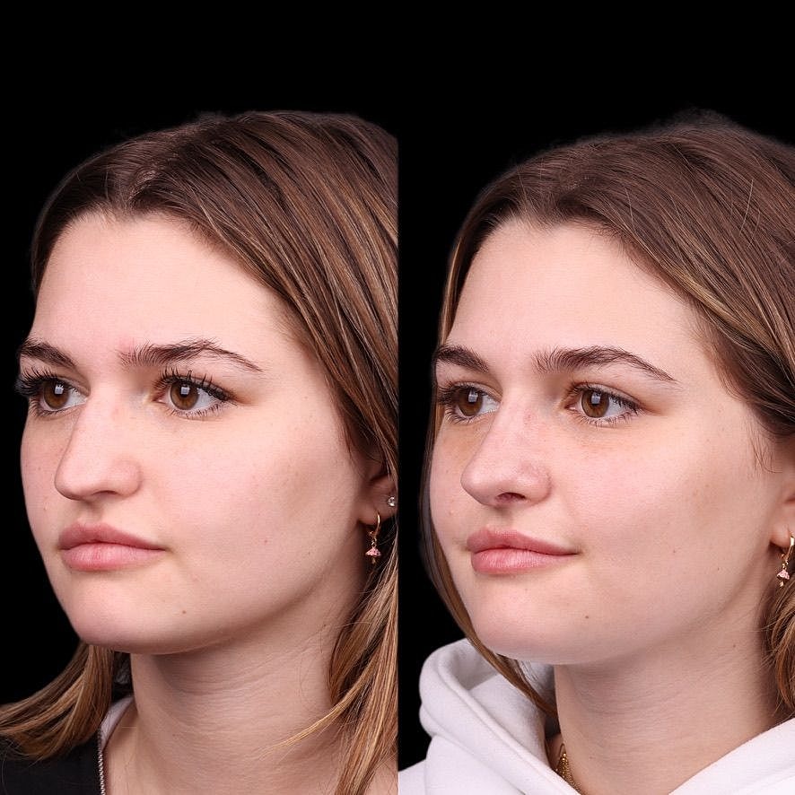 Cosmetic Primary Rhinoplasty Before & After