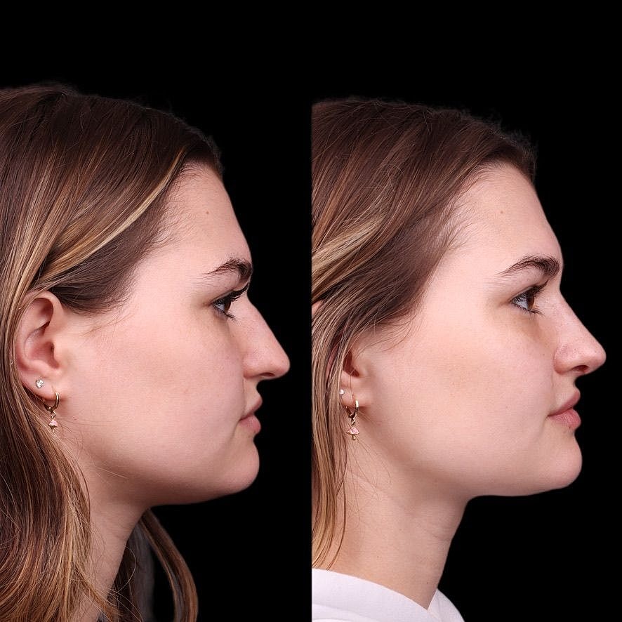 Cosmetic Primary Rhinoplasty Before & After