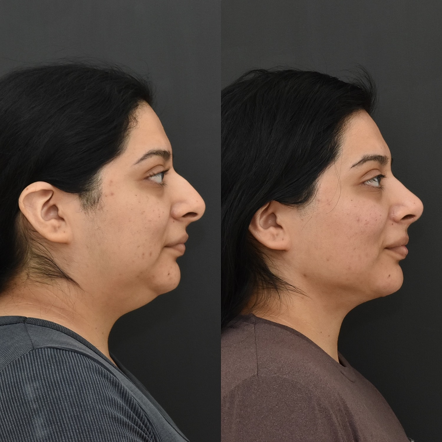Cosmetic Primary Rhinoplasty Before & After