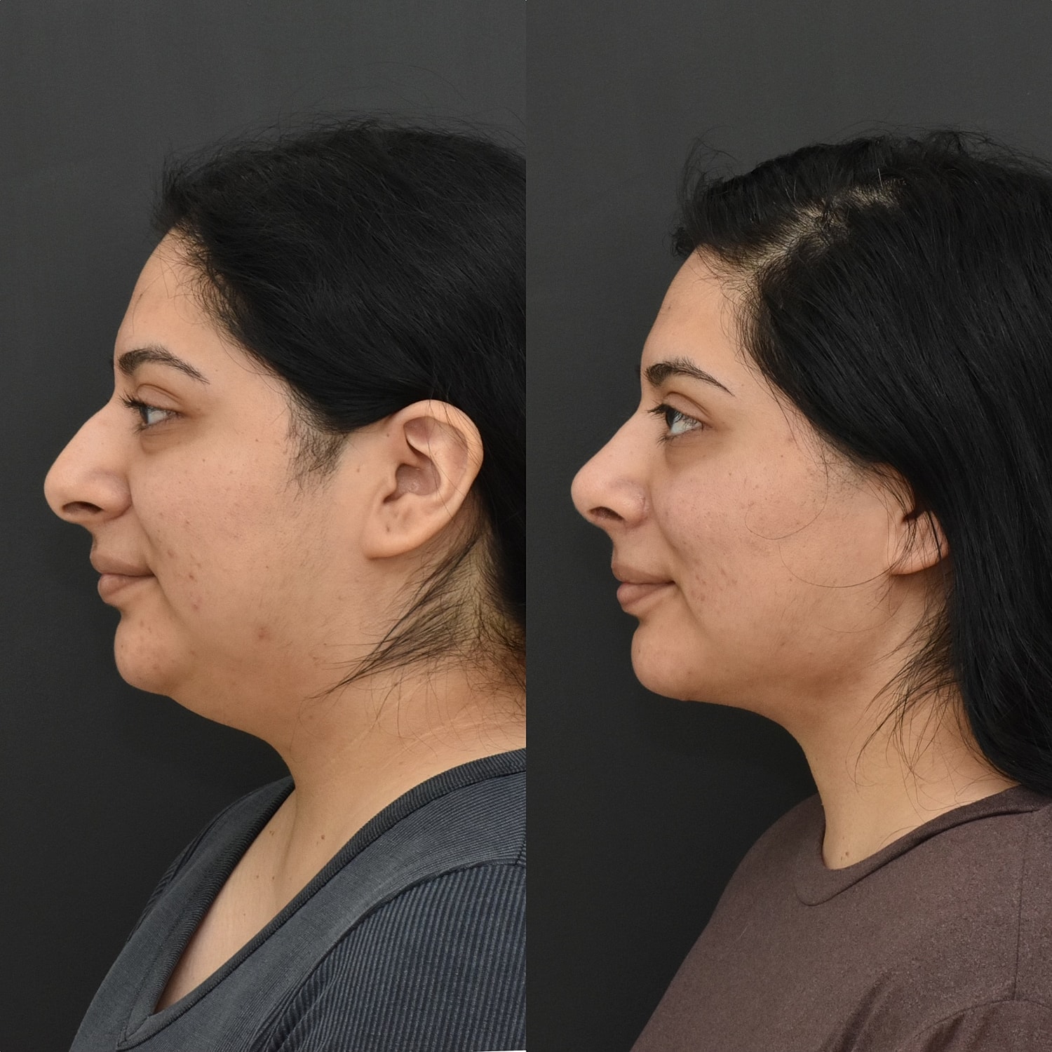 Cosmetic Primary Rhinoplasty Before & After