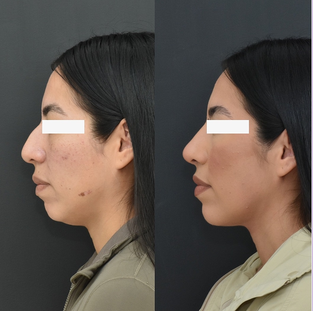 Cosmetic Primary Rhinoplasty Before & After