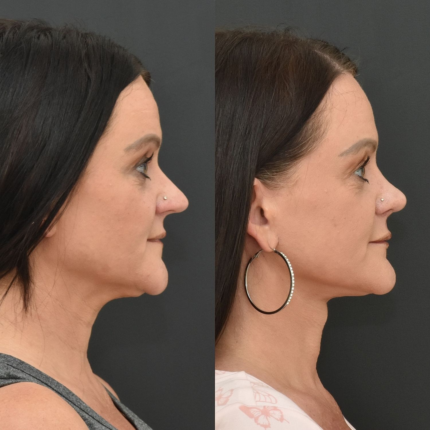 Cosmetic Primary Rhinoplasty Before & After