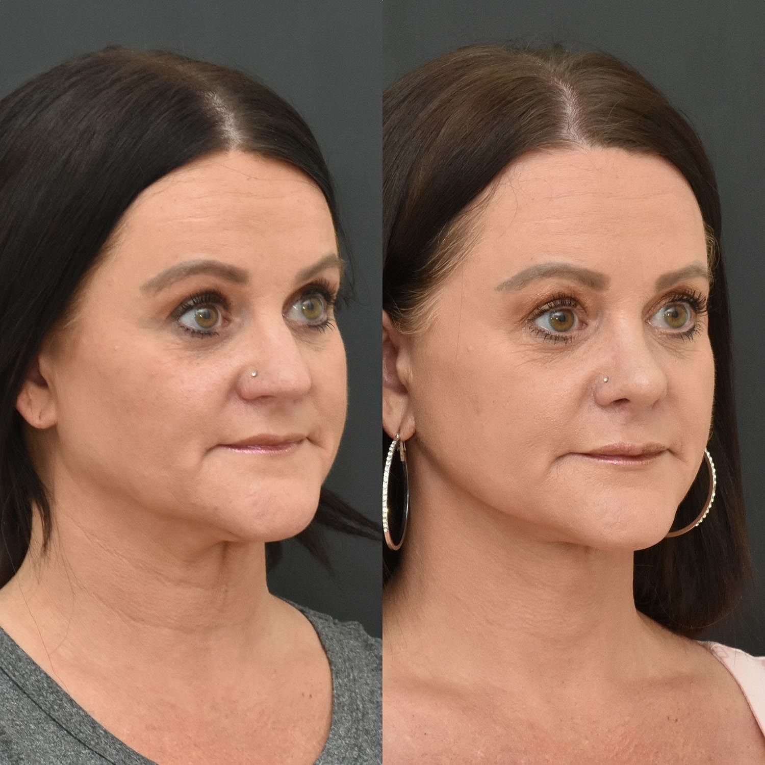 Cosmetic Primary Rhinoplasty Before & After