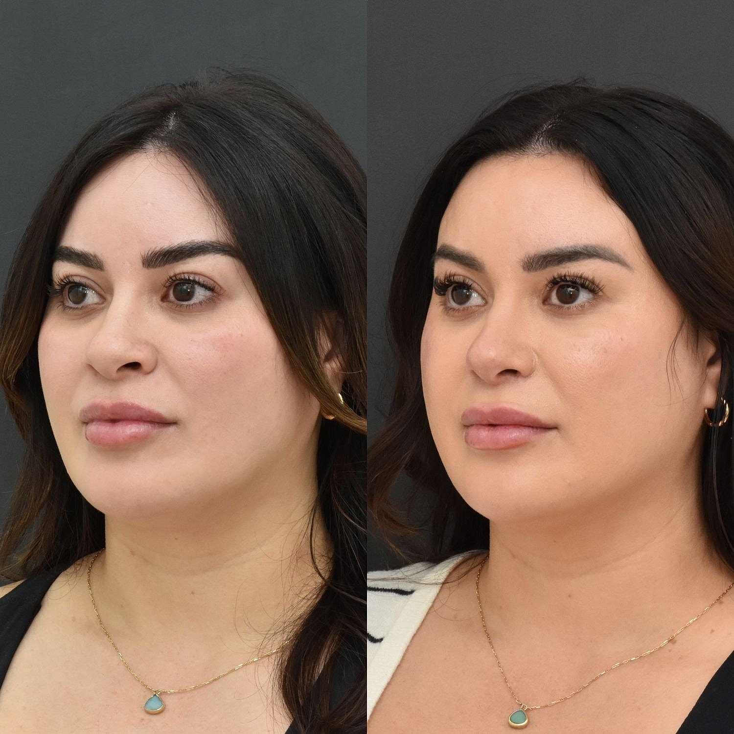 Cosmetic Primary Rhinoplasty Before & After