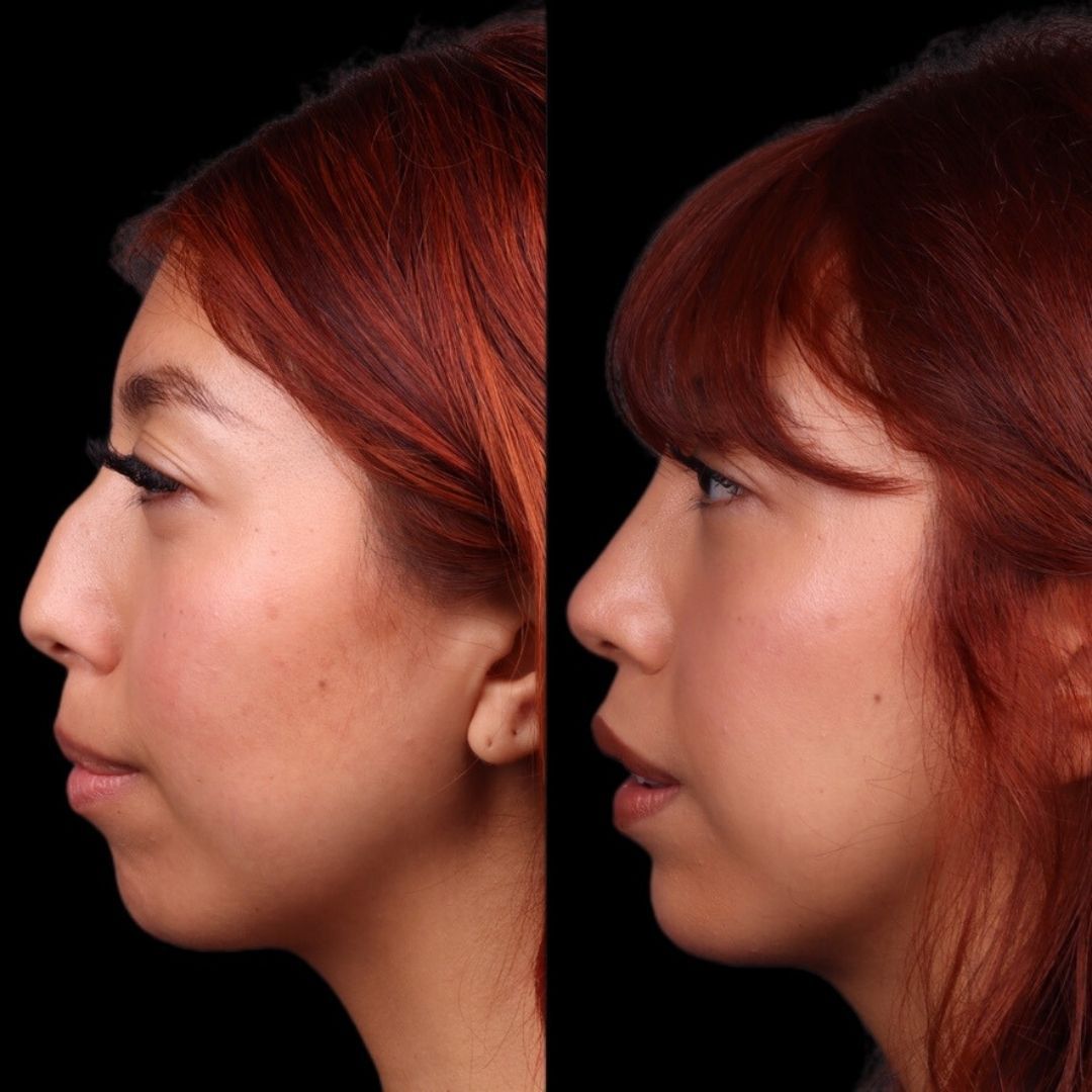 Cosmetic Primary Rhinoplasty Before & After