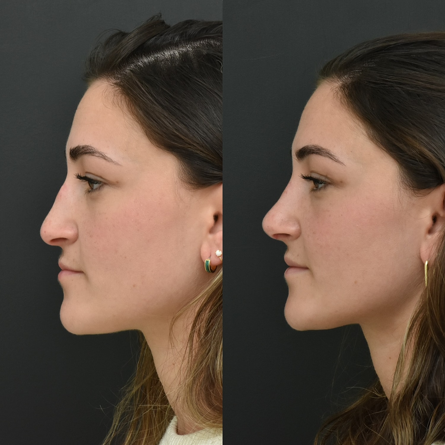 Cosmetic Primary Rhinoplasty Before & After
