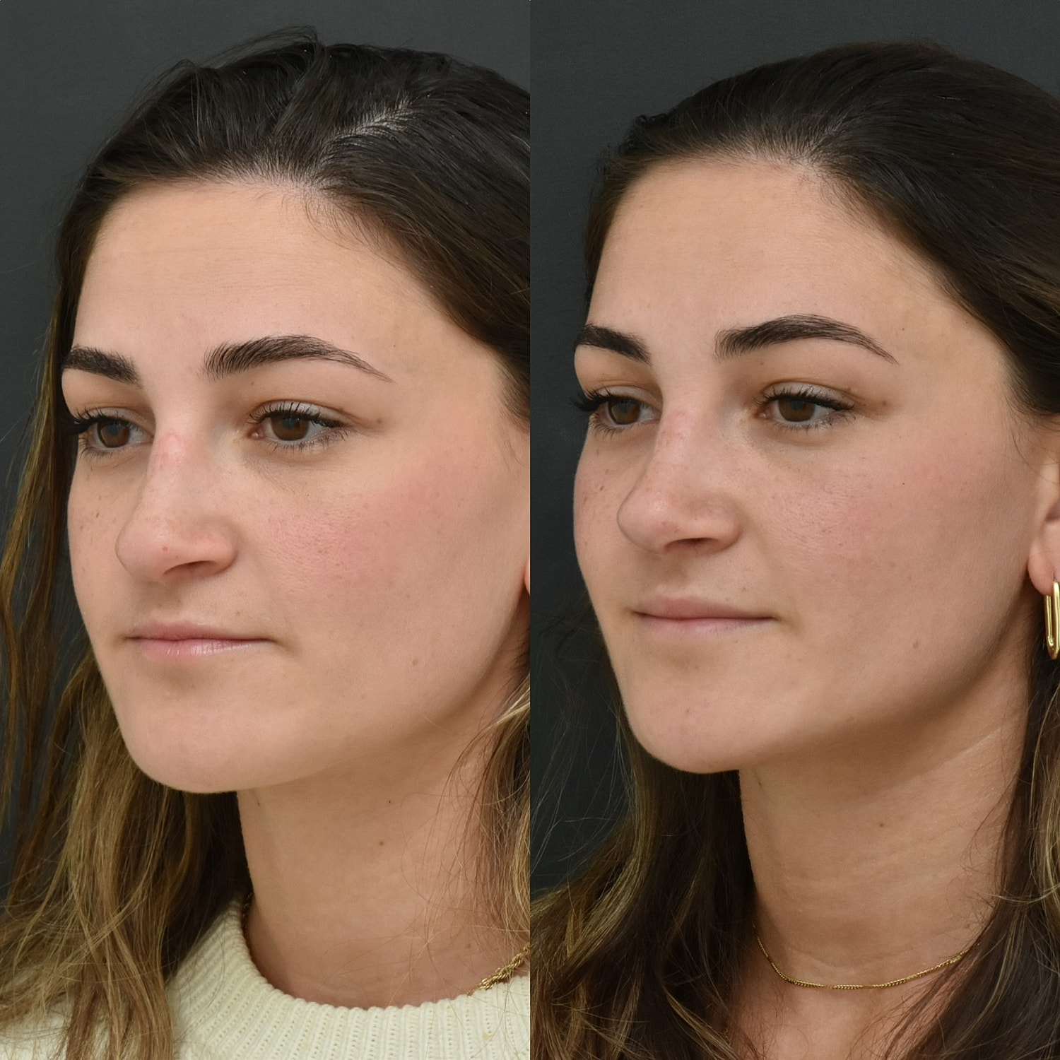Cosmetic Primary Rhinoplasty Before & After