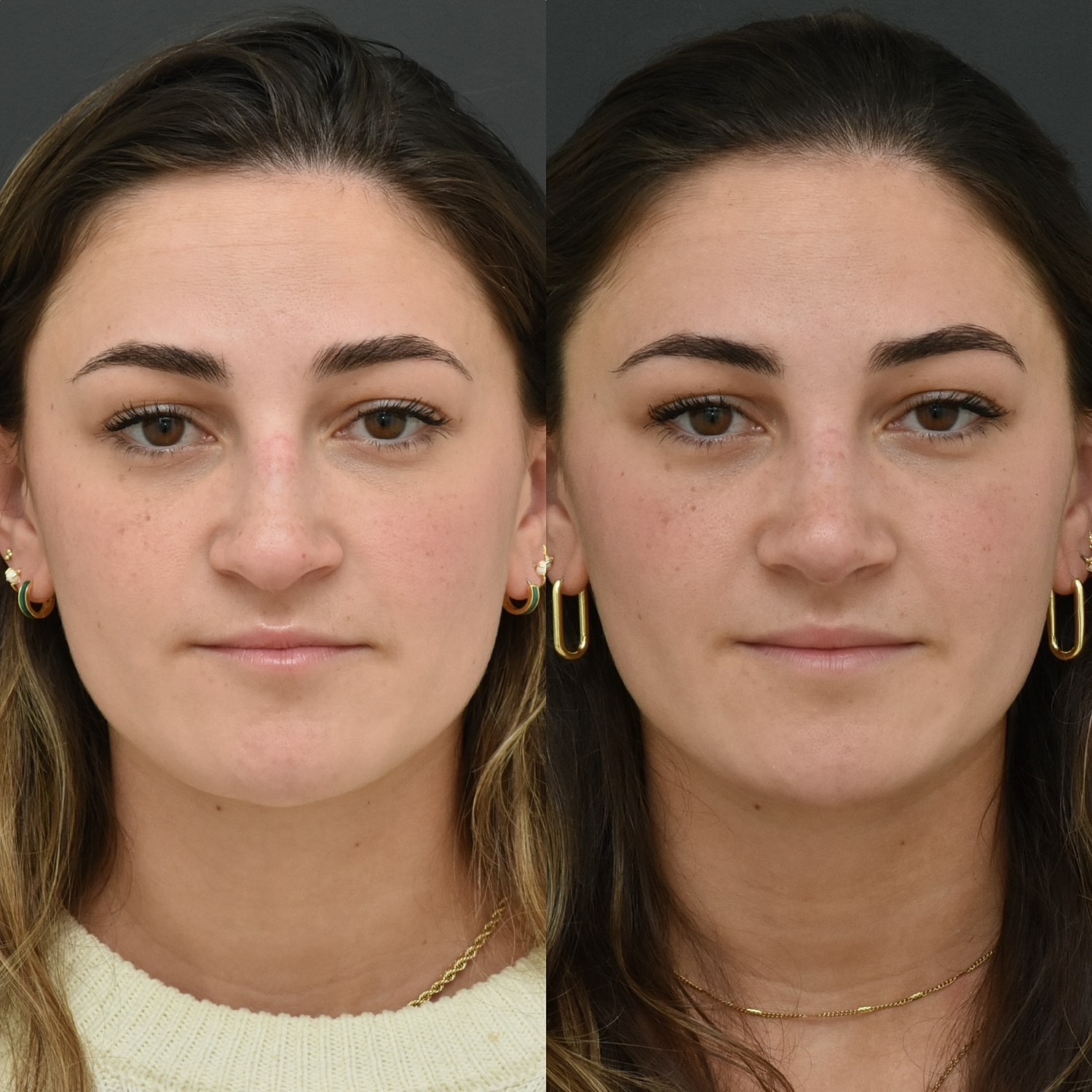Cosmetic Primary Rhinoplasty Before & After