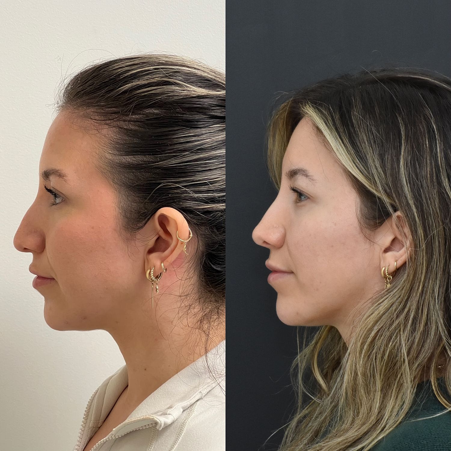 Cosmetic Primary Rhinoplasty Before & After