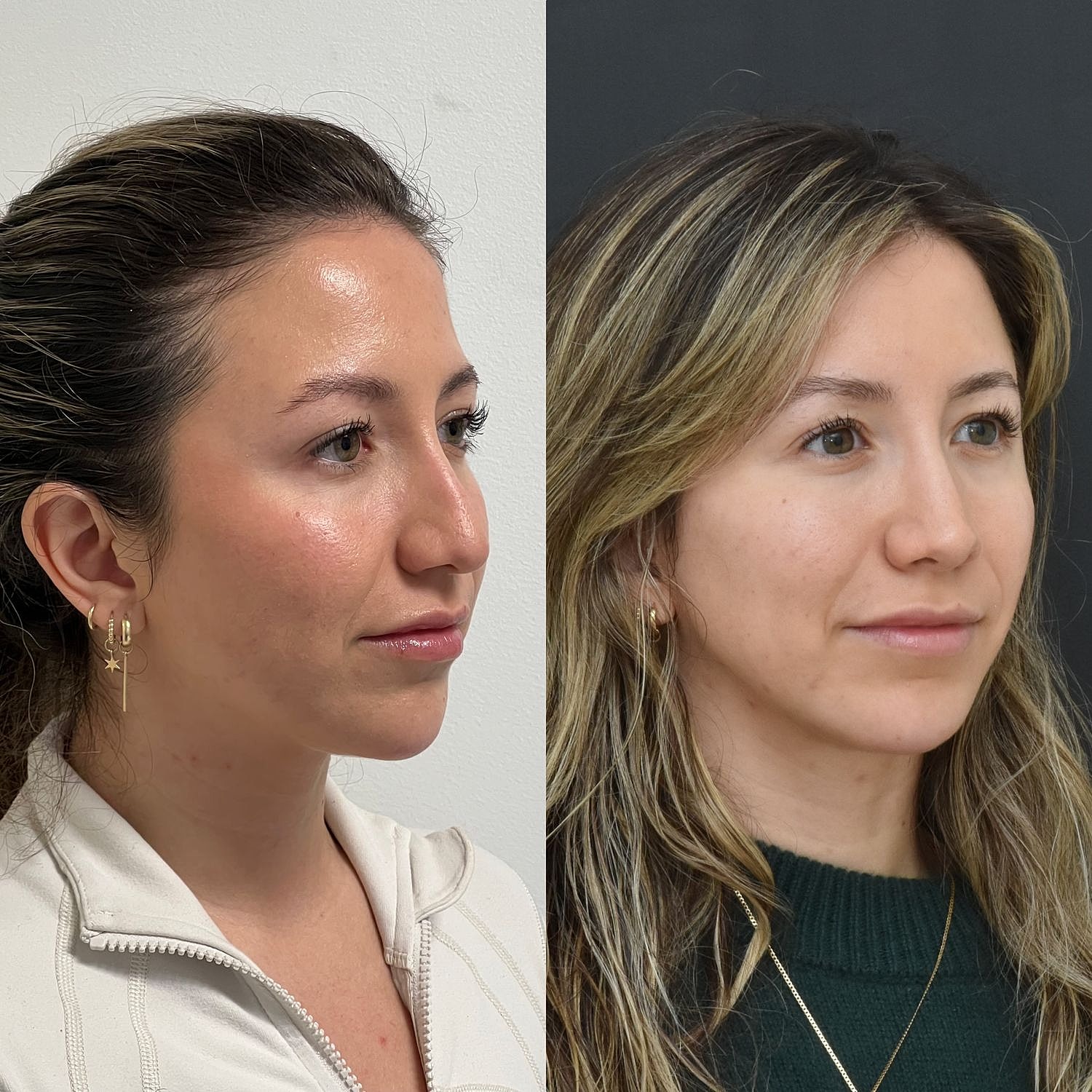 Cosmetic Primary Rhinoplasty Before & After