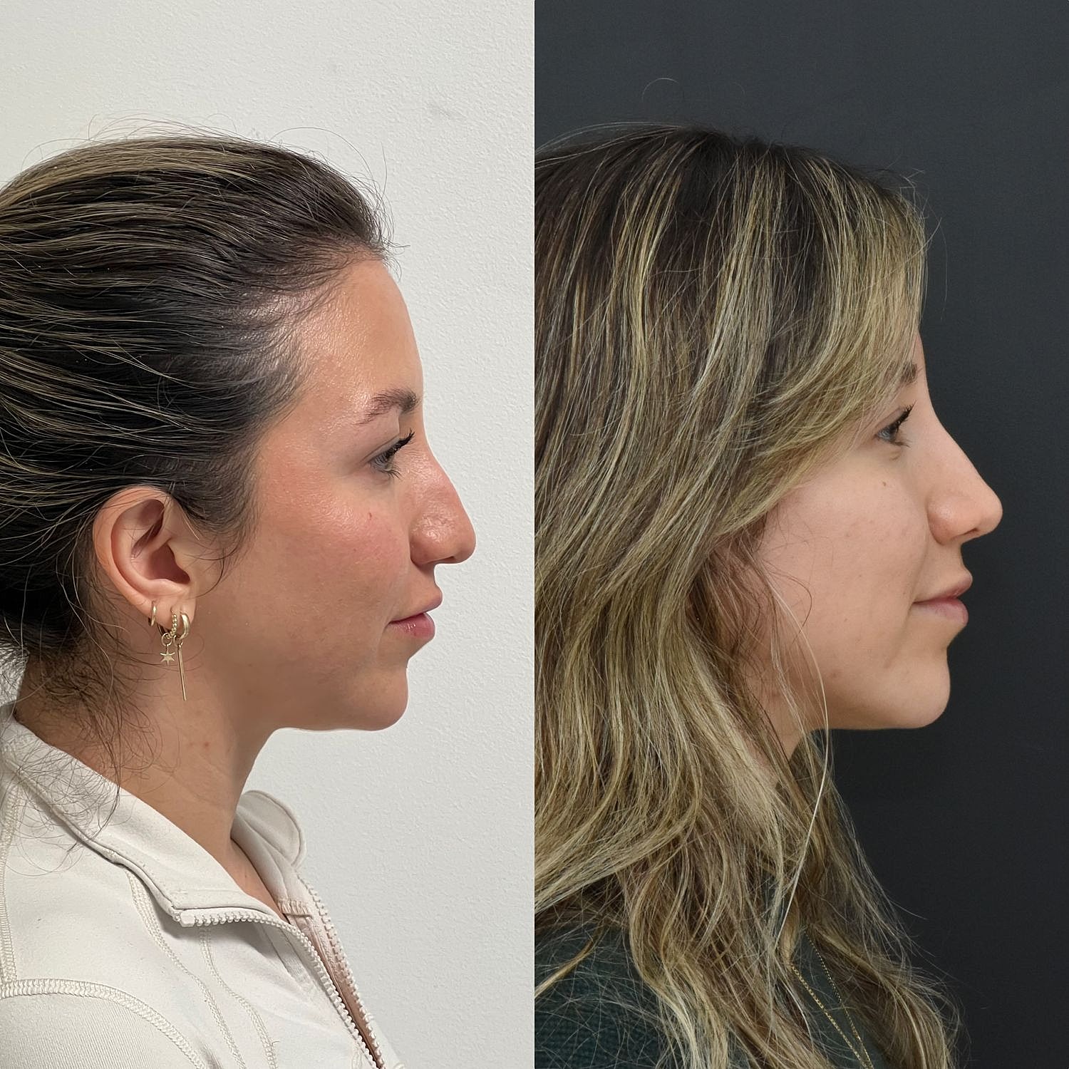 Cosmetic Primary Rhinoplasty Before & After